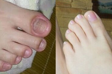 灰指甲治疗效果