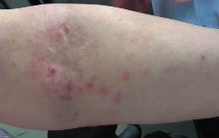 湿疹长在身体任何部位