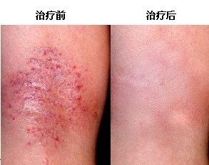 华医堂治疗皮炎效果对比