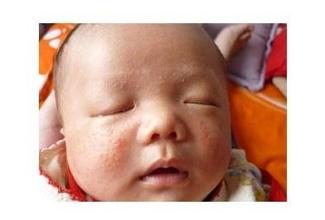 婴儿<a href='http://www.fzpfc.com/sz/' target='_blank' title='湿疹'><span style='color: #0000ff'><strong>湿疹</strong></span></a>会传染吗?