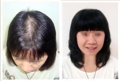 女性脱发怎么办