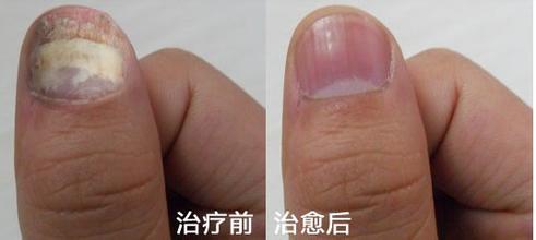 温州专业治疗灰指甲医院
