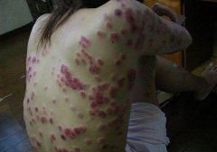 华医堂治疗女性牛皮癣